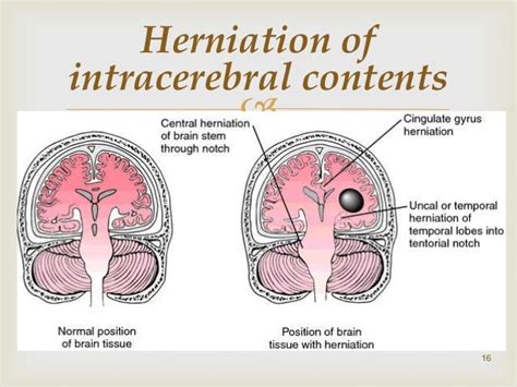 Increased intracranial pressure