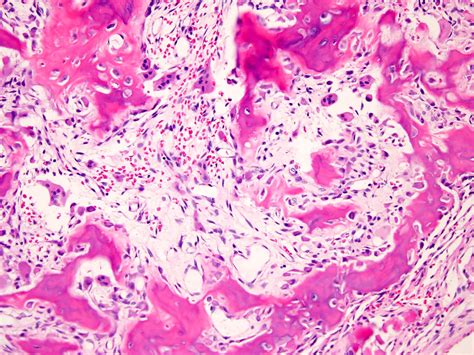 Osteoblastoma Histology