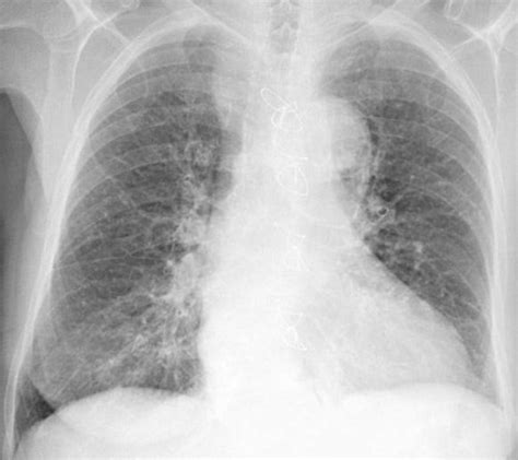 Chronic obstructive pulmonary diseases Flashcards | Quizlet