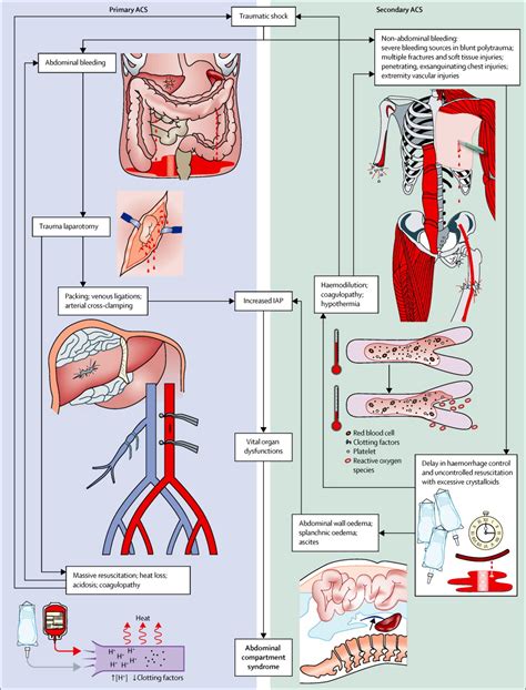 Postinjury abdominal compartment syndrome: from recognition to prevention - The Lancet