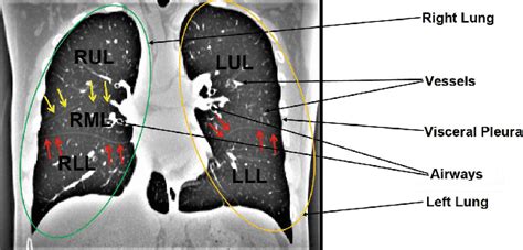 A coronal lung CT slice with visible fissures. Major fissures are ...