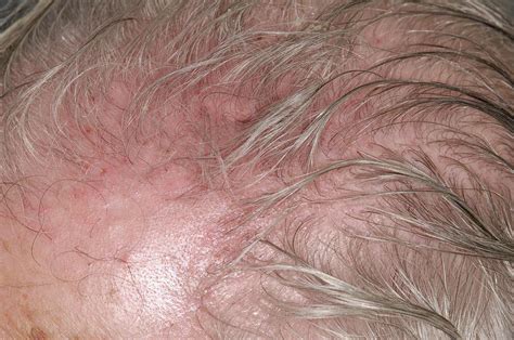 Scalp Irritation After Shingles Photograph by Dr P. Marazzi/science Photo Library