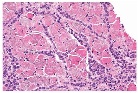 Invasive Lobular Carcinoma | Basicmedical Key