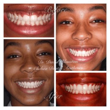 Gummy Smile Surgery - Chelsea New York, NY: Chelsea Dental Aesthetics