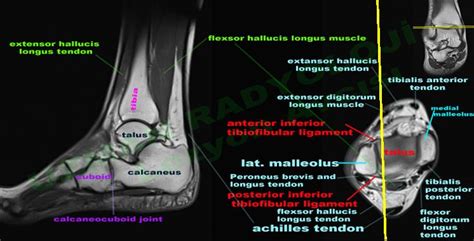 MRI ankle - Google Search | Medical anatomy, Foot anatomy, Mri