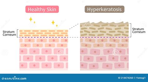 Diagram Of Thickening Of The Stratum Corneum And Woman Face. Before After Illustration. Skin ...