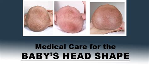 Medical Care for Baby Flat Head | Infant Flat Head Treatment in NJ