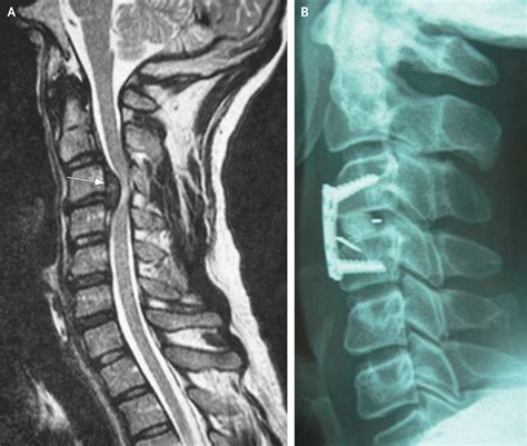 Post-Traumatic Herniated Cervical Disk | NEJM