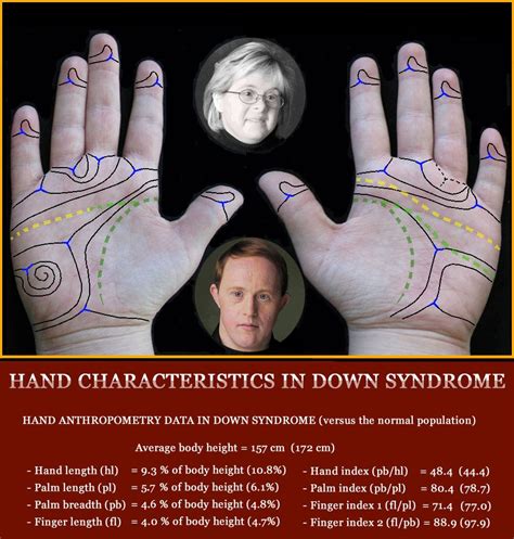 Down syndrome & the Hand: 32 Hand Signs! | Trisomy 21