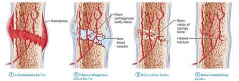 The four stages in the healing of a bone fracture are illustrated. | Human body anatomy, Body ...