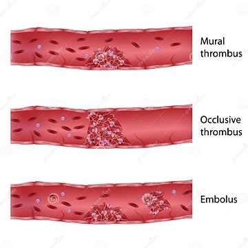 Types of thrombosis stock vector. Illustration of platelets - 27641173