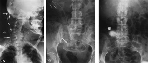 The Adult Radiographic Shuntogram | American Journal of Neuroradiology