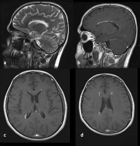 Neuromyelitis optica with linear enhancement of corpus callosum in brain magnetic resonance ...