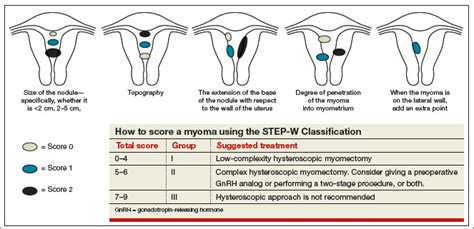 Hysteroscopic myomectomy using a mechanical approach | MDedge ObGyn