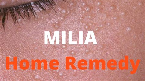 Milia Eyelid White Bumps On Face Not Milia / Milia Causes Treatments And Removal Of Tiny White ...