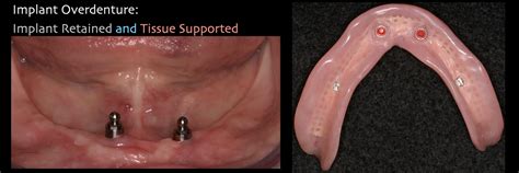 Case Study - Overdenture Procedure