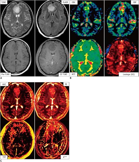 Case of clinical application of perfusion MRI methods in patient with ...