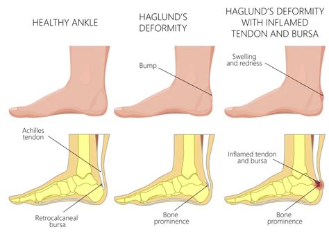 About Haglund's Deformity - Caruso Foot & Ankle