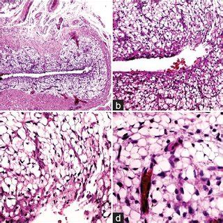 Mucous Retention Cyst Lip Histology | Sitelip.org