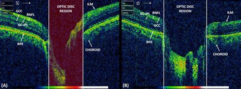 Optic nerve head (ONH) OCT scan depicting (A) healthy and (B)... | Download Scientific Diagram