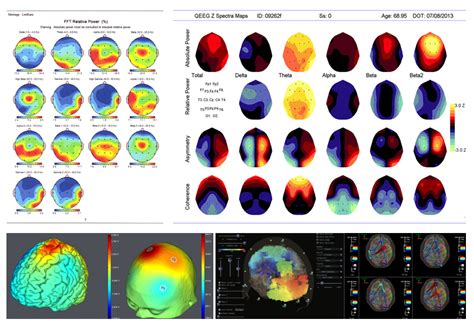 QEEG or quantitative EEG brain maps is the first step in helping you improve the quality of your ...