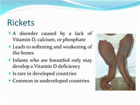 PPT - Rickets Disease PowerPoint Presentation - ID:2568458