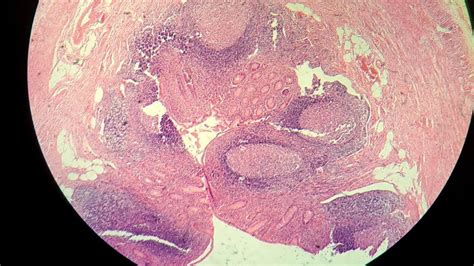 Ali Rashidimanesh on LinkedIn: What are the symptoms of goblet cell adenocarcinoma? Most ...