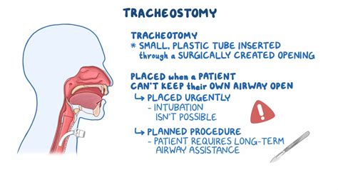 Tracheostomy - Osmosis Video Library