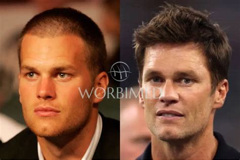 Tom Brady Hair Transplant l Before and After