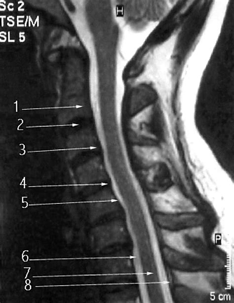 Abnormal Cervical Spine Mri