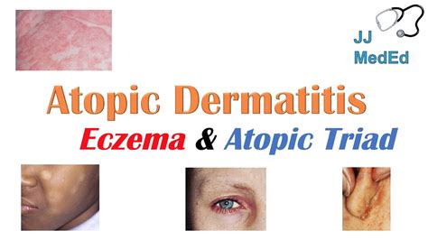 Eczema (Atopic Dermatitis) | Atopic Triad, Triggers, Who gets it, Why does it happen ...