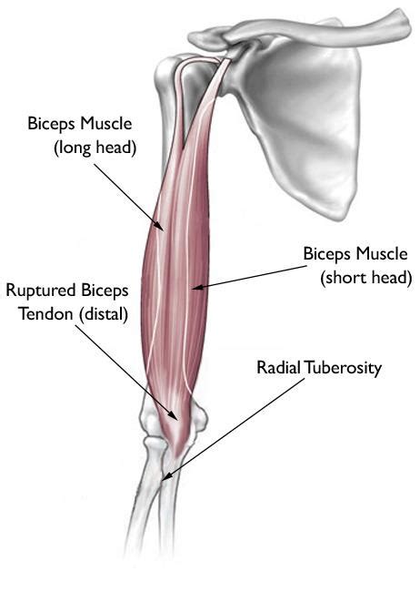 Biceps Tendon Tear at the Elbow - OrthoInfo - AAOS