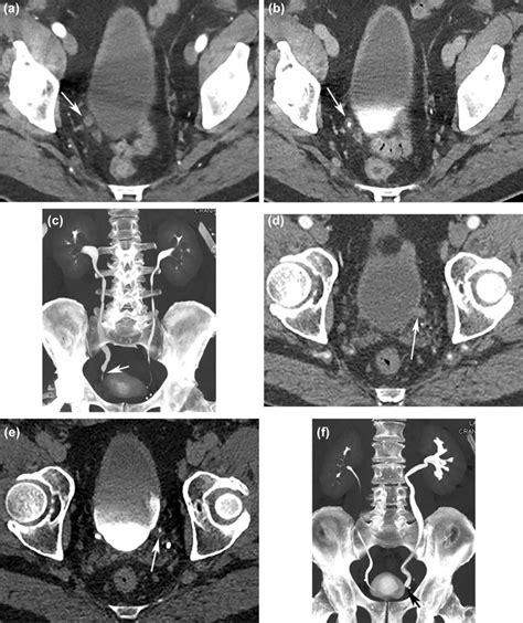 Ureterostomy Stent