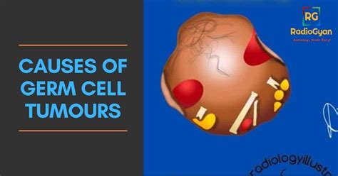 Germ Cell Tumors Subtypes - Visual Mnemonics - RadioGyan