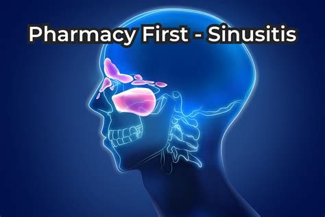 Sinusitis Treatment Broadstairs - Pharmacy First