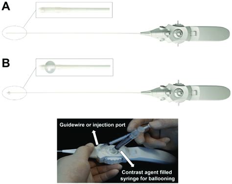 An inflatable balloon catheter (ZiNeu ® , JUVENUI, Seoul, Korea). An ...