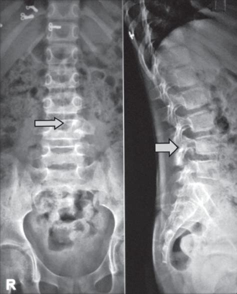 Plain X-ray showing expansion of the left fourth lumbar pedicle:... | Download Scientific Diagram