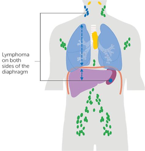 Hodgkin lymphoma causes, symptoms, diagnosis, stages, treatment & prognosis