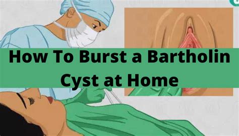 How To Burst a Bartholin Cyst at Home - Techvtimes