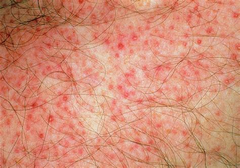 Close-up Of Red Folliculitis Papules On Skin Photograph by Dr. Chris ...