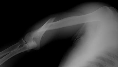 Humerus Fracture (Upper Arm Fracture) | Johns Hopkins Medicine