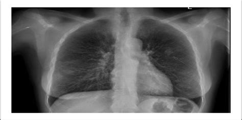 “Crack Lung”: A Pulmonary Complication of Crack Cocaine Case : Journal ...