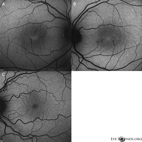 Idiopathic Juxtafoveal Telangiectasia Type II (Macular Telangiectasia type 2) | Abstract artwork ...