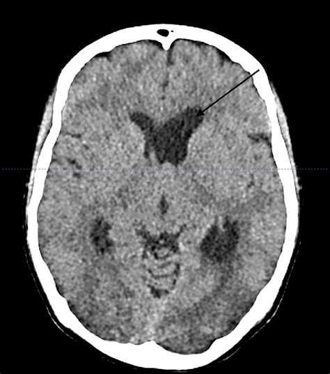 Figure 1 from Foramen of Monro choroid plexus papilloma: An extremely ...