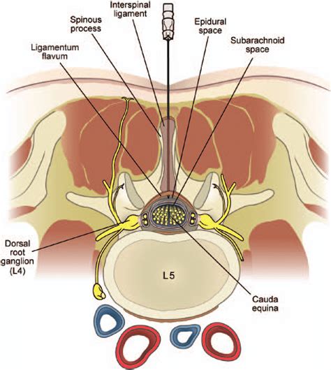 Axial diagram of interlaminar lumbar epidural injection. The epidural... | Download Scientific ...