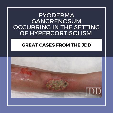 Pyoderma Gangrenosum Occurring in the Setting of Hypercortisolism - Next Steps in Dermatology