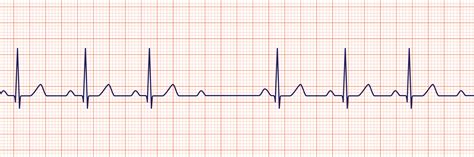 ACLS Rhythm Strips Training and Interpretation