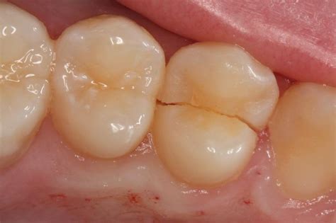 Cracked Tooth/Teeth | American College of Prosthodontists