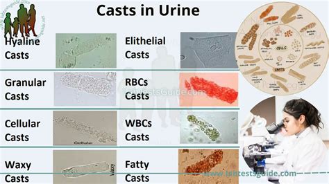 Casts in Urine | Lab Tests Guide