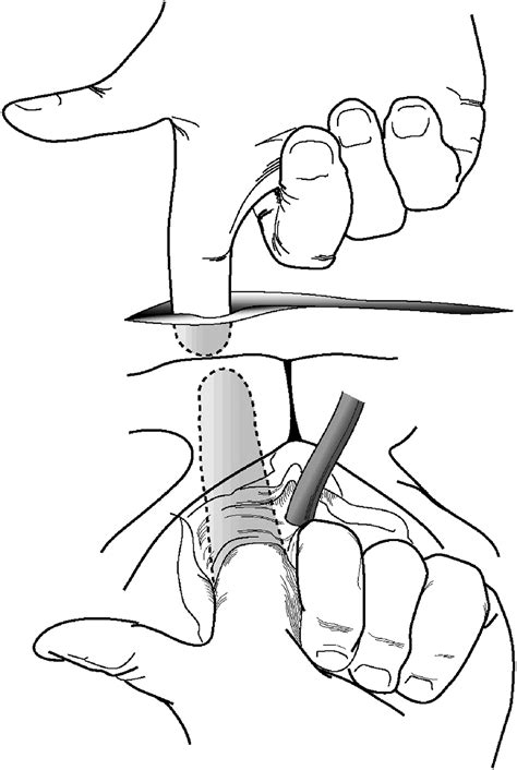 Pubovaginal Fascial Sling for the Treatment of all Types of Stress Urinary Incontinence ...